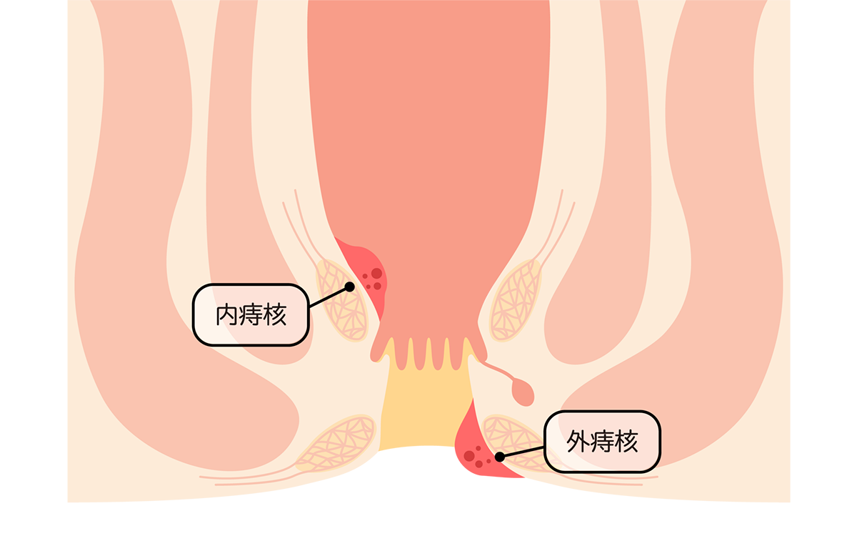 いぼ痔とは