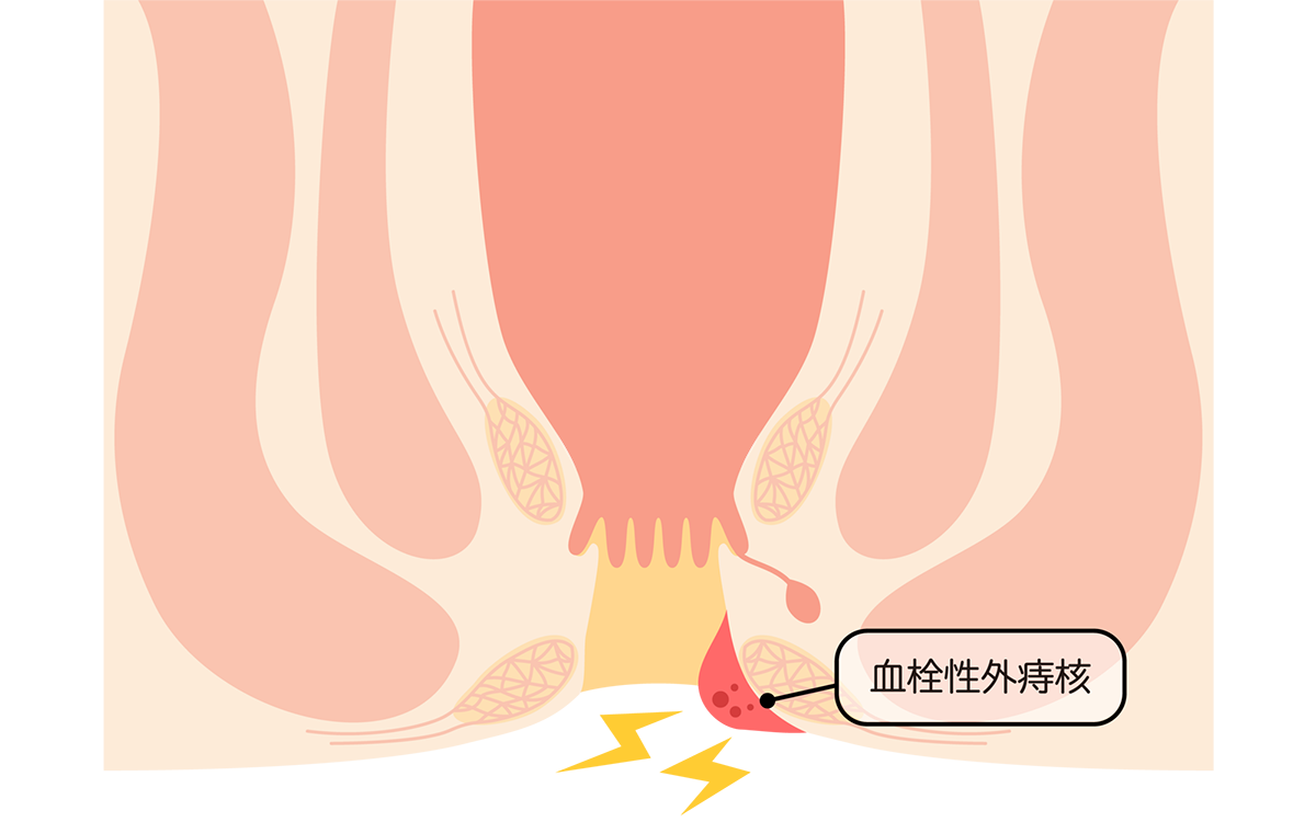 血栓性外痔核について