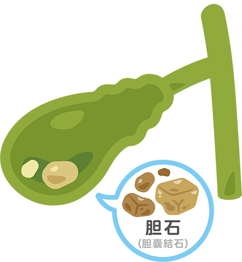 胆石は自然になくなる？