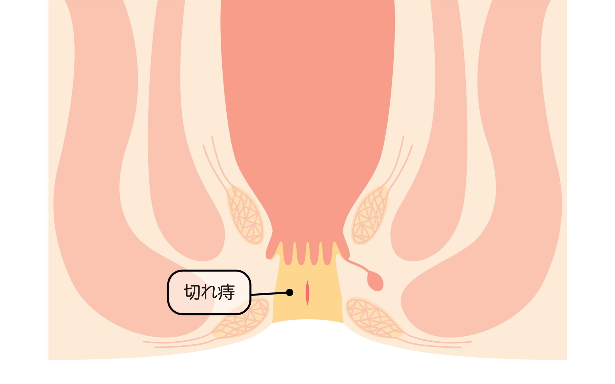切れ痔とは