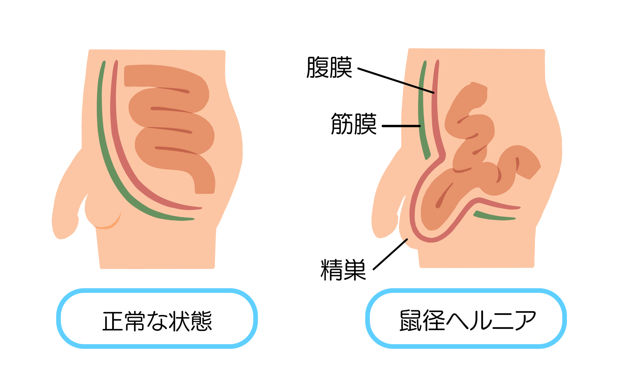 脱腸、鼠経ヘルニア